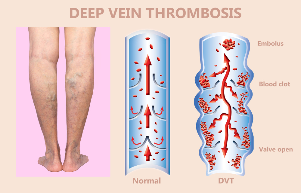 Dvt Deep Vein Thrombosis Dvt Treatment In Missouri